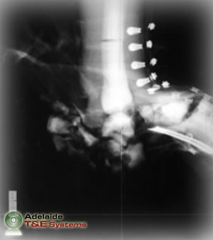 Frangible Surrogate Leg (FSL)